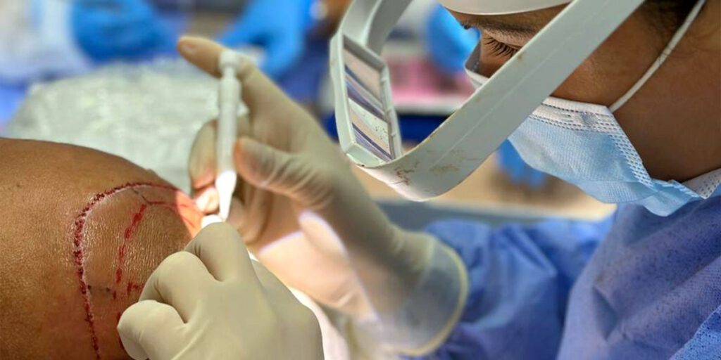 Clínica de implante capilar en Barranquilla: expertos en regeneración capilar