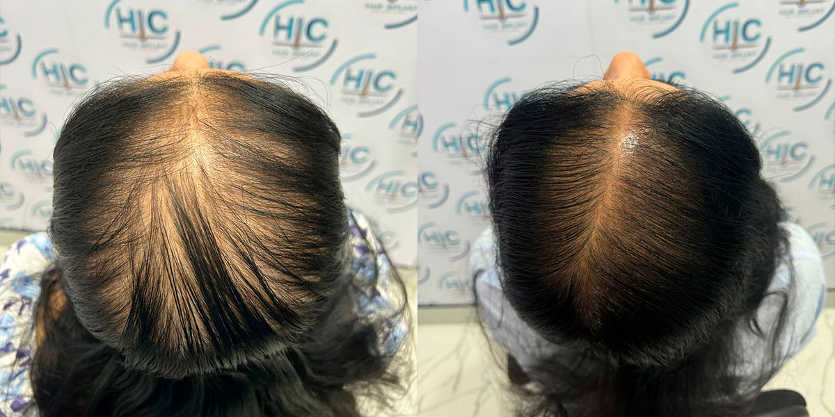 Clínica de implante capilar en Barranquilla