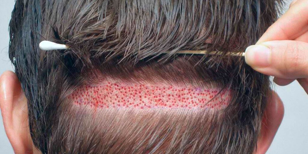 Clínica de implante capilar en Barranquilla