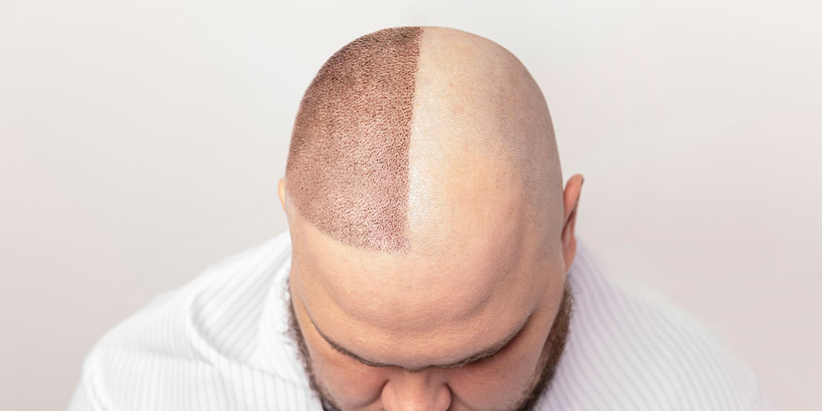 Mitos y verdades sobre el implante capilar