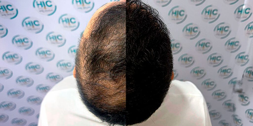 10 Verdades Impactantes y Mitos Desmentidos sobre el Implante Capilar