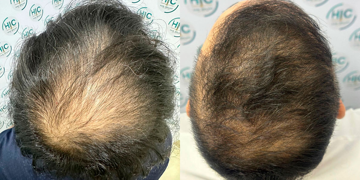 Qué es un implante capilar