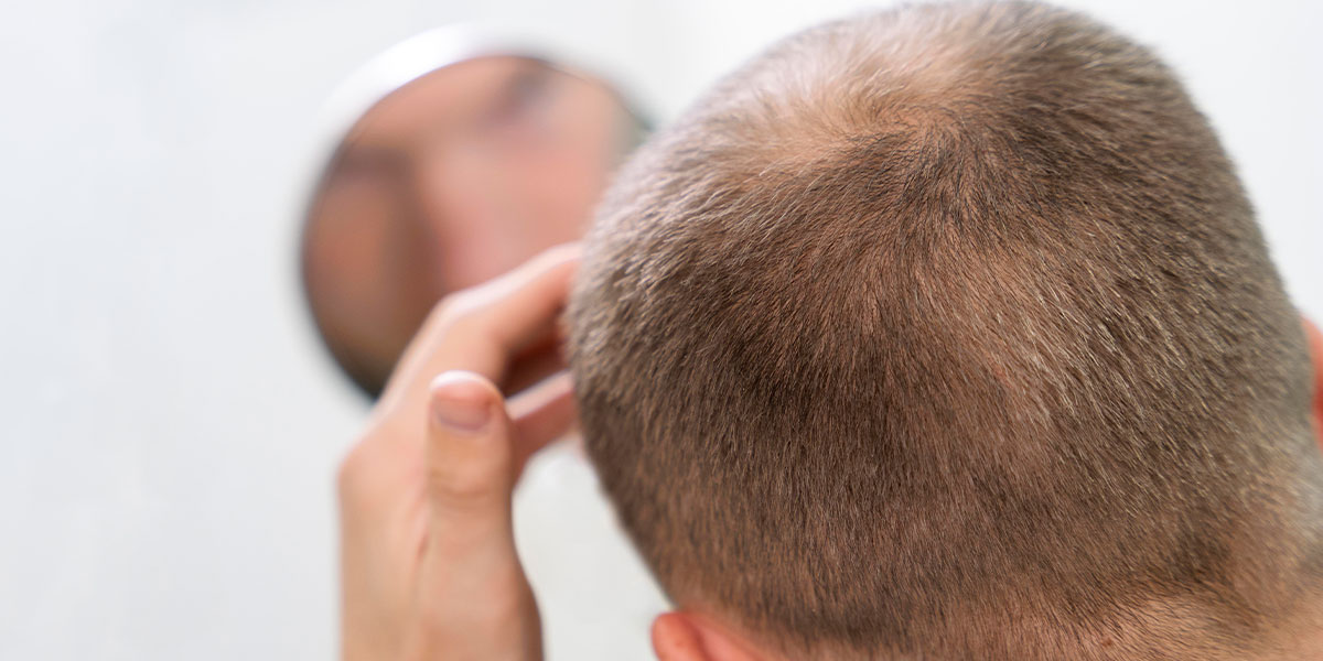 Implante capilar sin rapar Guía completa