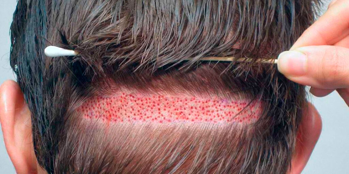 Implante capilar sin rapar Guía completa