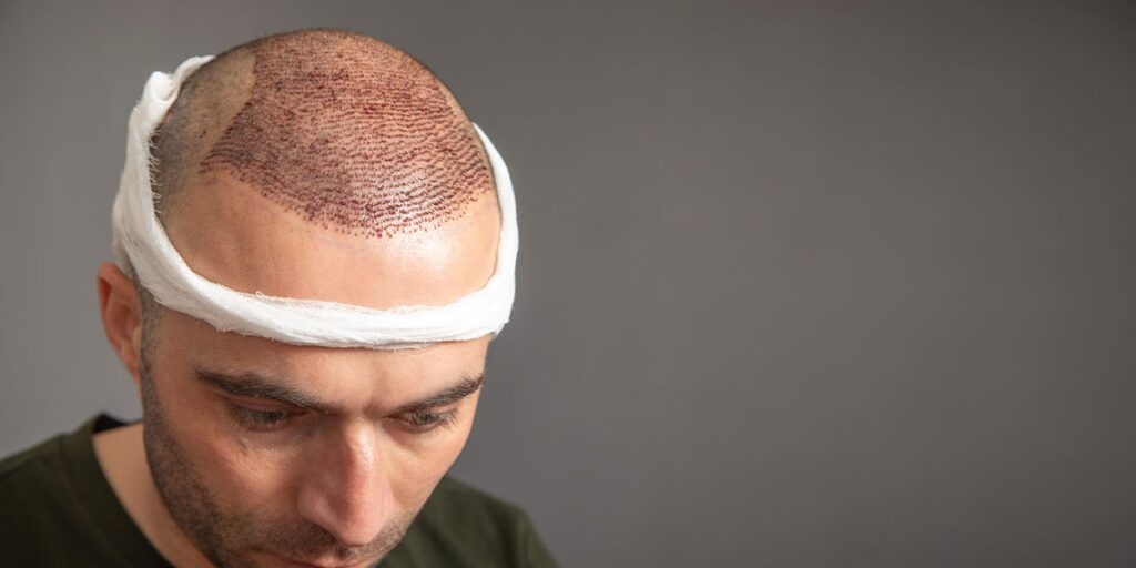 ¿Cuánto dura la hinchazón después de un implante capilar y cómo reducirla de forma segura?