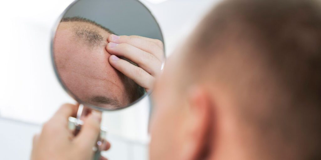 Alopecia Androgenética: Qué es, Causas, Tratamientos y Solución Definitiva