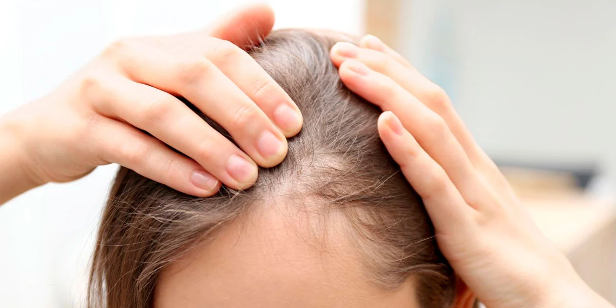 Alopecia Androgenética