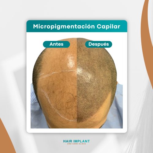 micropigmentacion capilar resultados micropigmentacion capilar resultados